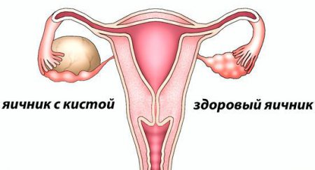 Как отличить беременность от кисты яичников